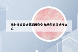 脓包性银屑病是基因突变 脓胞型银屑病传染吗