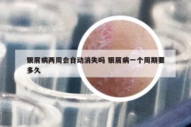 银屑病两周会自动消失吗 银屑病一个周期要多久