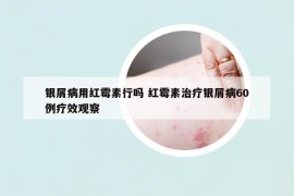 银屑病用红霉素行吗 红霉素治疗银屑病60例疗效观察