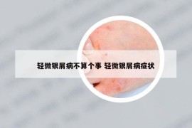 轻微银屑病不算个事 轻微银屑病症状