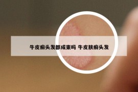 牛皮癣头发都成束吗 牛皮肤癣头发