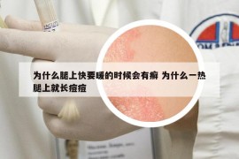 为什么腿上快要暖的时候会有癣 为什么一热腿上就长痘痘