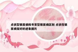 点状型银屑病和寻常型银屑病区别 点状性银屑病变好的迹象图片