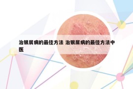 治银屑病的最佳方法 治银屑病的最佳方法中医