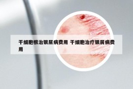 干细胞根治银屑病费用 干细胞治疗银屑病费用