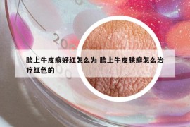 脸上牛皮癣好红怎么为 脸上牛皮肤癣怎么治疗红色的