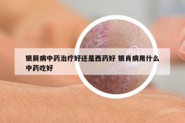 银屙病中药治疗好还是西药好 银肖病用什么中药吃好