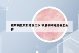 银屑病复发扣掉皮出水 银屑病掉完皮会怎么样