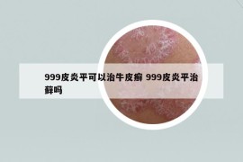 999皮炎平可以治牛皮癣 999皮炎平治藓吗