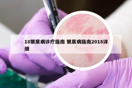 18银屑病诊疗指南 银屑病指南2018详细