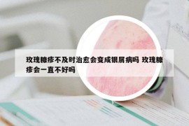 玫瑰糠疹不及时治愈会变成银屑病吗 玫瑰糠疹会一直不好吗