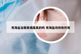 死海盐治银屑病是真的吗 死海盐功效和作用