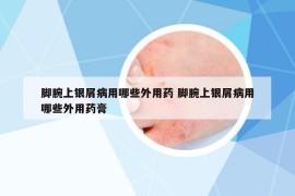 脚腕上银屑病用哪些外用药 脚腕上银屑病用哪些外用药膏