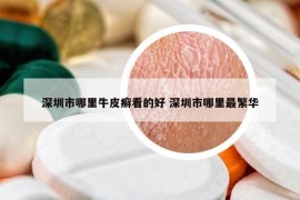 深圳市哪里牛皮癣看的好 深圳市哪里最繁华