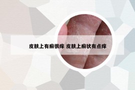 皮肤上有癣很痒 皮肤上癣状有点痒