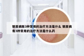 银屑病有3种常用的治疗方法是什么 银屑病有3种常用的治疗方法是什么药