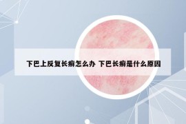 下巴上反复长癣怎么办 下巴长癣是什么原因