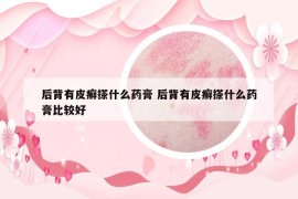 后背有皮癣搽什么药膏 后背有皮癣搽什么药膏比较好