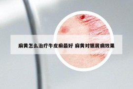 麻黄怎么治疗牛皮癣最好 麻黄对银屑病效果