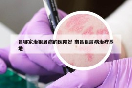 昌哪家治银屑病的医院好 南昌银屑病治疗基地