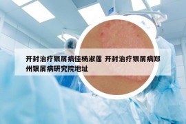 开封治疗银屑病佳杨淑莲 开封治疗银屑病郑州银屑病研究院地址