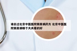 谁去过北京中医医院银屑病药方 北京中医医院银屑病哪个大夫看的好