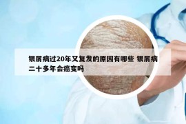 银屑病过20年又复发的原因有哪些 银屑病二十多年会癌变吗