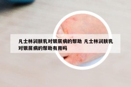 凡士林润肤乳对银屑病的帮助 凡士林润肤乳对银屑病的帮助有用吗