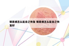 银屑病怎么能自己恢复 银屑病怎么能自己恢复好