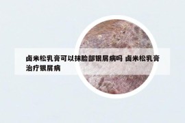 卤米松乳膏可以抹脸部银屑病吗 卤米松乳膏治疗银屑病