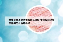 女生皮肤上突然体癣怎么治疗 女生皮肤上突然体癣怎么治疗最好