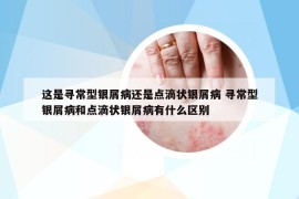 这是寻常型银屑病还是点滴状银屑病 寻常型银屑病和点滴状银屑病有什么区别