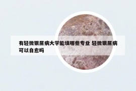 有轻微银屑病大学能填哪些专业 轻微银屑病可以自愈吗