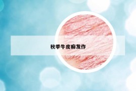 秋季牛皮癣发作