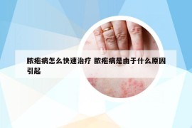 脓疱病怎么快速治疗 脓疱病是由于什么原因引起