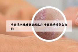 手足浓泡反反复复怎么办 手足脓疱疹怎么来的