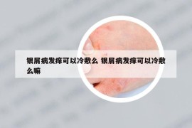 银屑病发痒可以冷敷么 银屑病发痒可以冷敷么嘛