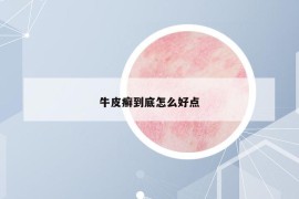 牛皮癣到底怎么好点