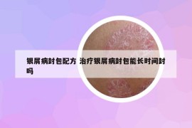 银屑病封包配方 治疗银屑病封包能长时间封吗