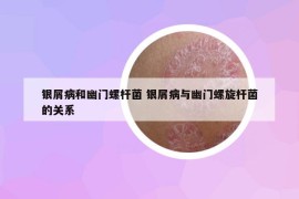 银屑病和幽门螺杆菌 银屑病与幽门螺旋杆菌的关系