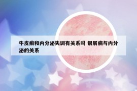 牛皮癣和内分泌失调有关系吗 银屑病与内分泌的关系