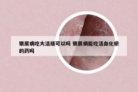 银屑病吃大活络可以吗 银屑病能吃活血化瘀的药吗