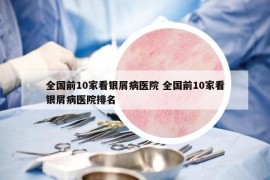 全国前10家看银屑病医院 全国前10家看银屑病医院排名