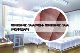 银屑病影响公务员体检不 银屑病影响公务员体检不过关吗