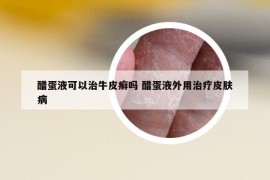 醋蛋液可以治牛皮癣吗 醋蛋液外用治疗皮肤病