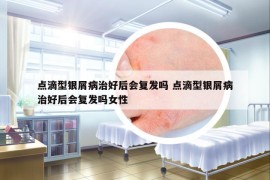 点滴型银屑病治好后会复发吗 点滴型银屑病治好后会复发吗女性