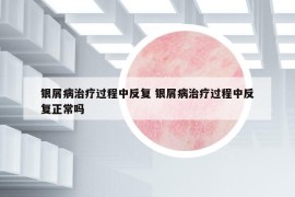 银屑病治疗过程中反复 银屑病治疗过程中反复正常吗