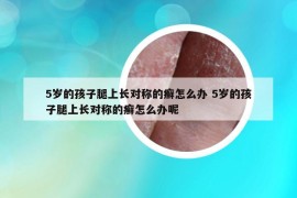 5岁的孩子腿上长对称的癣怎么办 5岁的孩子腿上长对称的癣怎么办呢