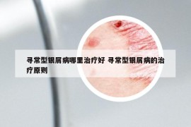 寻常型银屑病哪里治疗好 寻常型银屑病的治疗原则