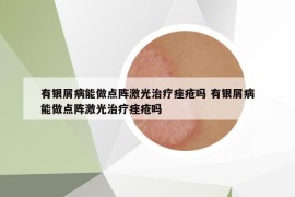 有银屑病能做点阵激光治疗痤疮吗 有银屑病能做点阵激光治疗痤疮吗